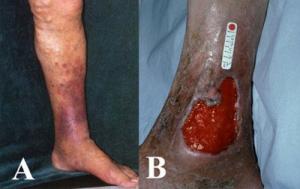 Différents types de varices sur les jambes d'une femme
